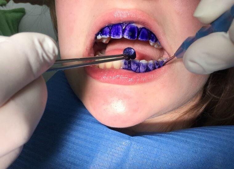 Zahnprophylaxe für Kinder